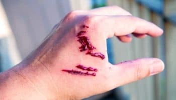 Niños fueron atacados por murciélago mientras dormían: Secretaría de Salud de Oaxaca