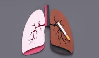 Supervivencia a cáncer de pulmón sube de 23 al 60 % con diagnóstico temprano, dice experta