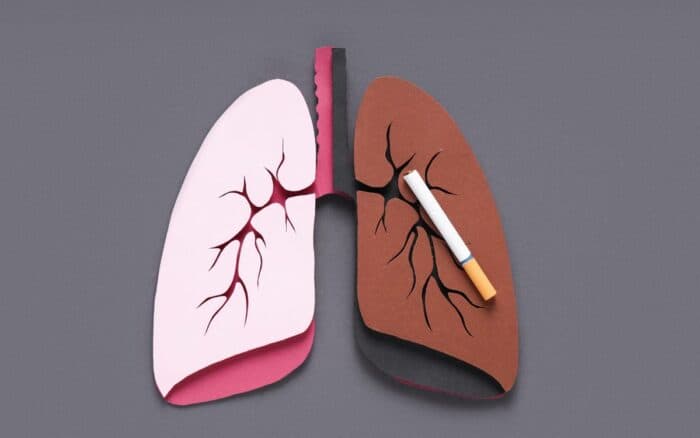 Supervivencia a cáncer de pulmón sube de 23 al 60 % con diagnóstico temprano, dice experta