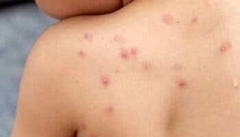 OMS declara nuevamente el mpox como una emergencia internacional de salud pública