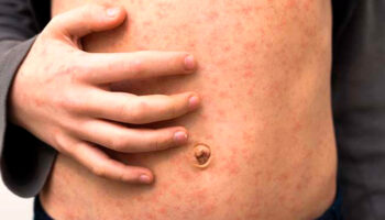 México encabeza muertes por sarampión en América y es segundo en contagios: Informe de la OPS