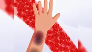 Uno de cada 10 mil mexicanos padece hemofilia; la mitad no lo sabe