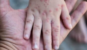 Coxsackie: estos son los síntomas del virus que causó alerta en Hidalgo