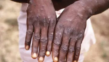 ¿Hay rebrote de la viruela del mono en África?