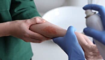 Hospital en Sevilla usa piel artificial en tratamiento para grandes quemados