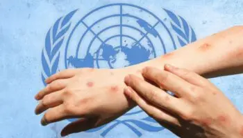 OMS intenta transmitir tranquilidad ante brote de Mpox: 'No es la Covid'