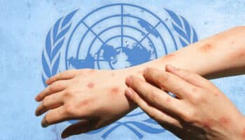 OMS intenta transmitir tranquilidad ante brote de Mpox: 'No es la Covid'