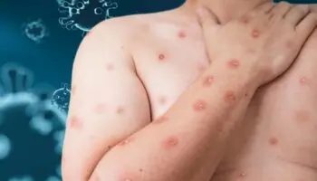 Nayarit: Hombre abandona hospital con posible diagnóstico de Mpox
